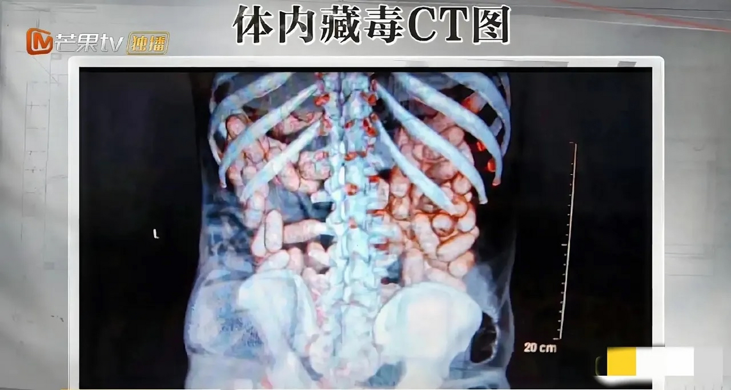 这是一张真实的人体运毒ct,粉红色的就是毒品,被藏在人体的胃和肠道