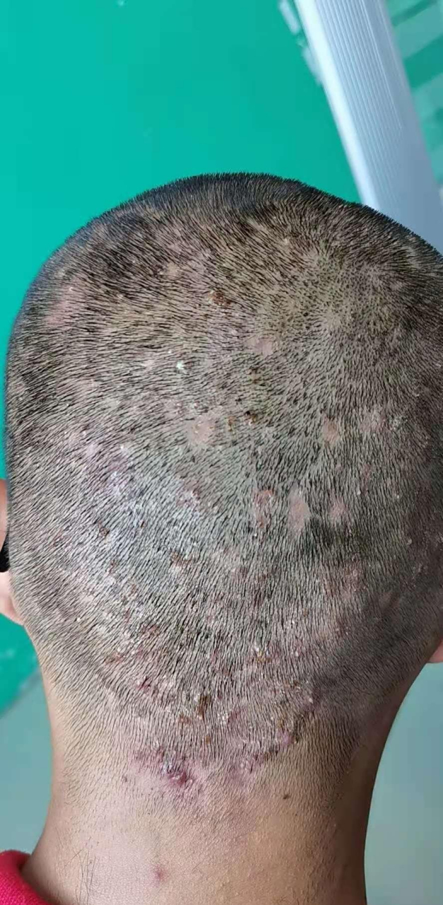 毛囊炎真的很讨厌,但如果你不注意生活习惯,吃再多药也没用!