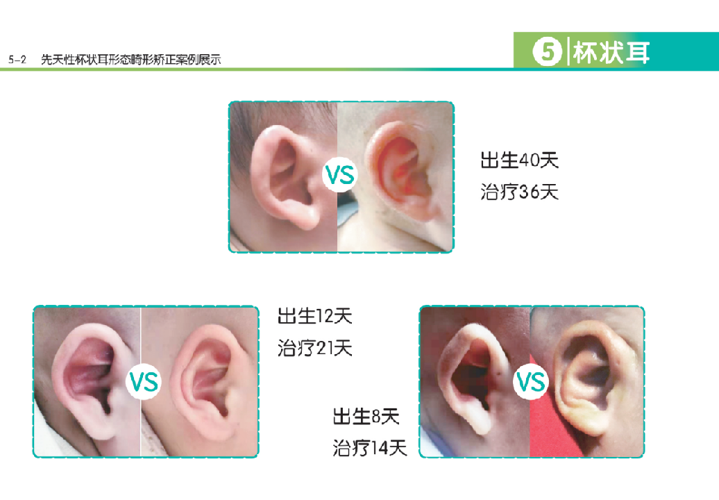 新生儿先天性耳廓畸形的筛查及治疗流程