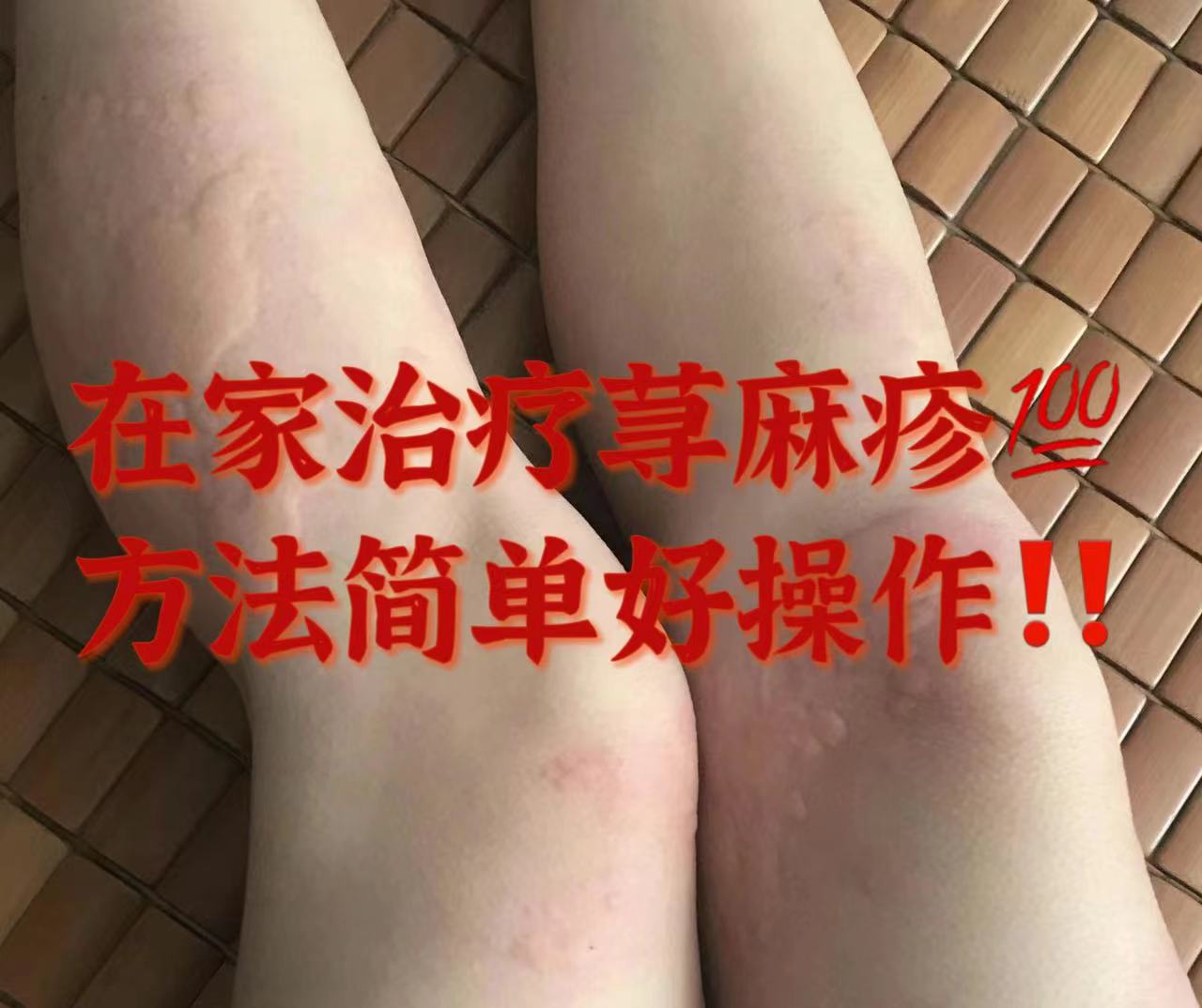 慢性荨麻疹有救了!消疹止痒不用吃药!每天在家一抹轻松痊愈!
