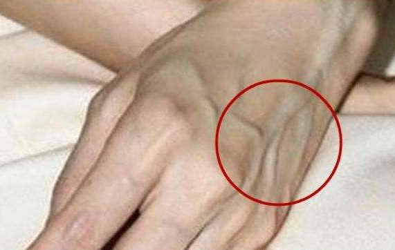 有人手背"青筋暴起",而有的人几乎看不到青筋,哪个更健康?