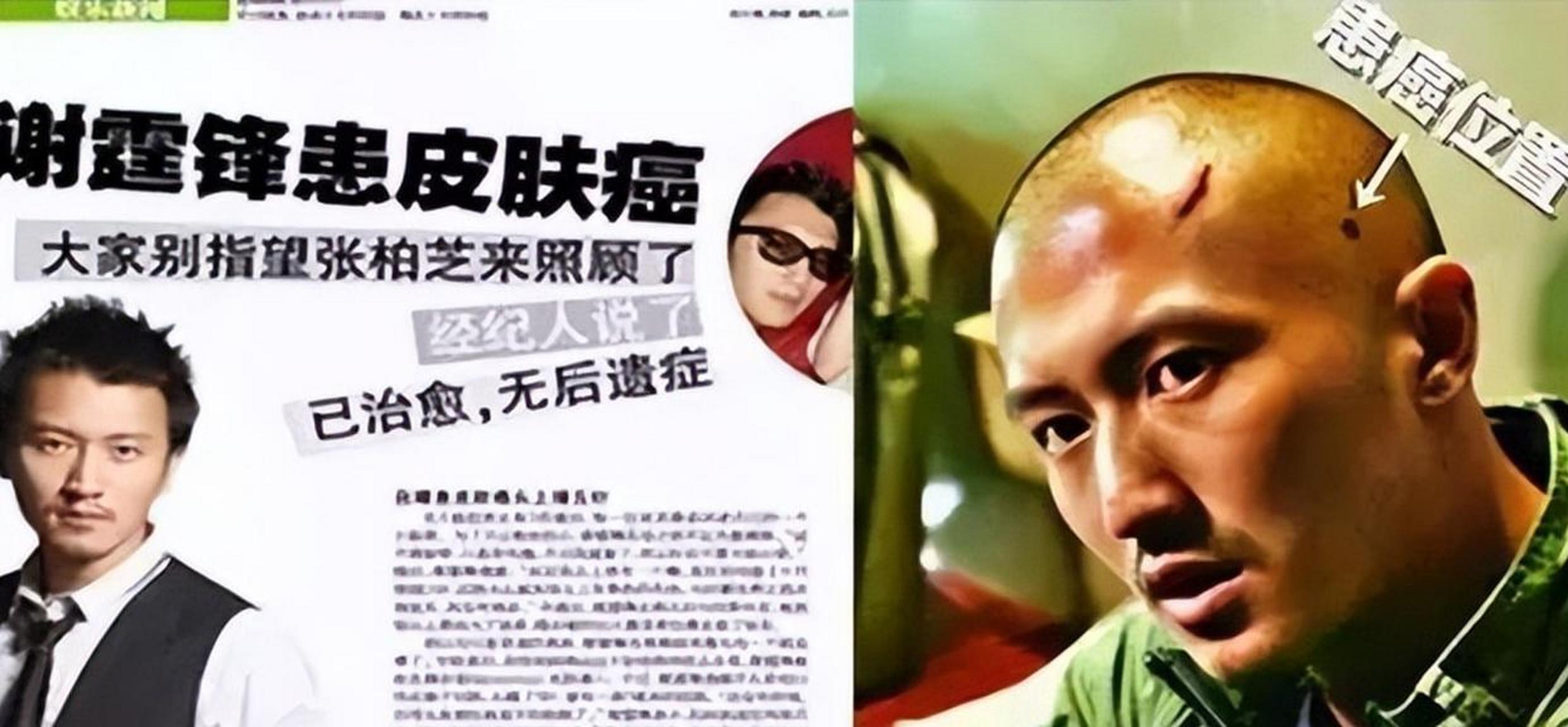 因拍戏需要剃光头意外发现头上的痣,确诊了早期皮肤癌继而治愈,谢霆锋