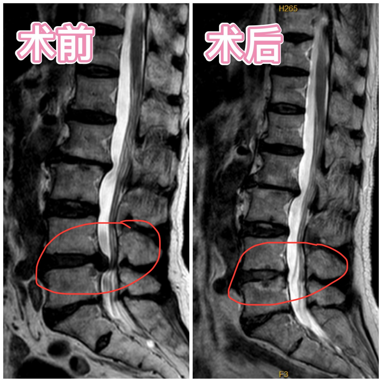 腰间盘突出ct图片对比图片