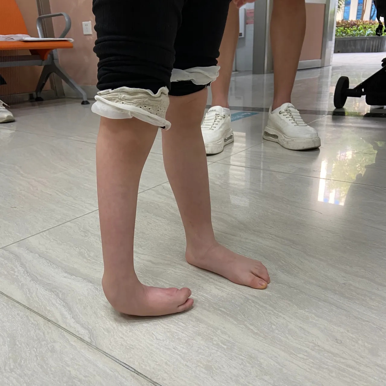 5岁女孩,右脚马蹄内翻足,从出生的时候就这样,家住云南,市区的医院没