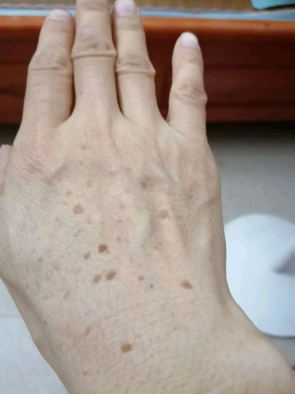 才三十几岁,这几年手背上就长满了这些东西,像斑不是斑,像痣不是痣