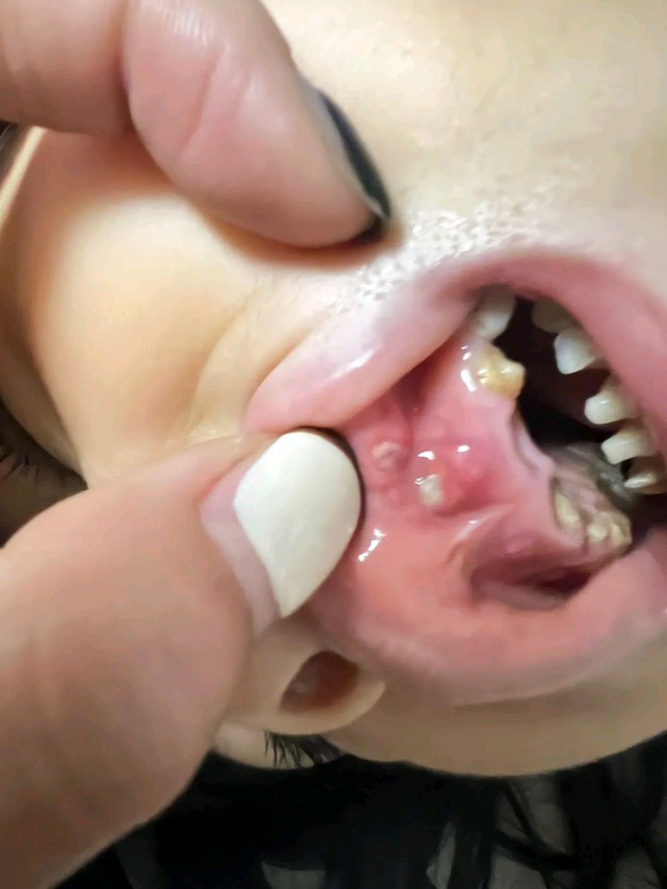 我真的服了,4岁半,牙齿就这样了……  牙根把牙龈戳破了……咋搞咋?