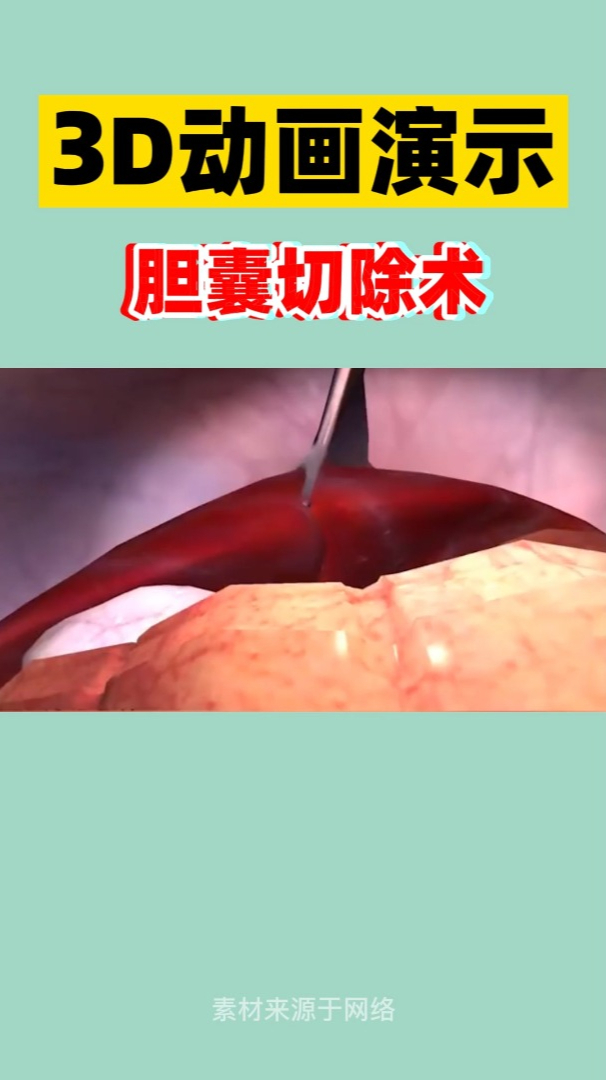 3d动画模拟:胆囊切除术过程-度小视