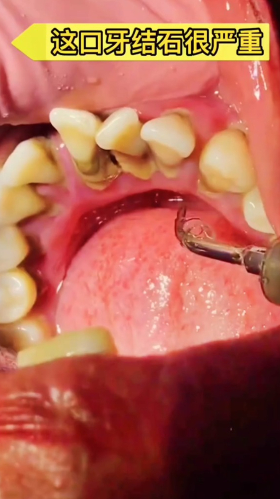 牙结石牙污垢牙菌斑如何生成和祛除,关键是日常预防和保养
