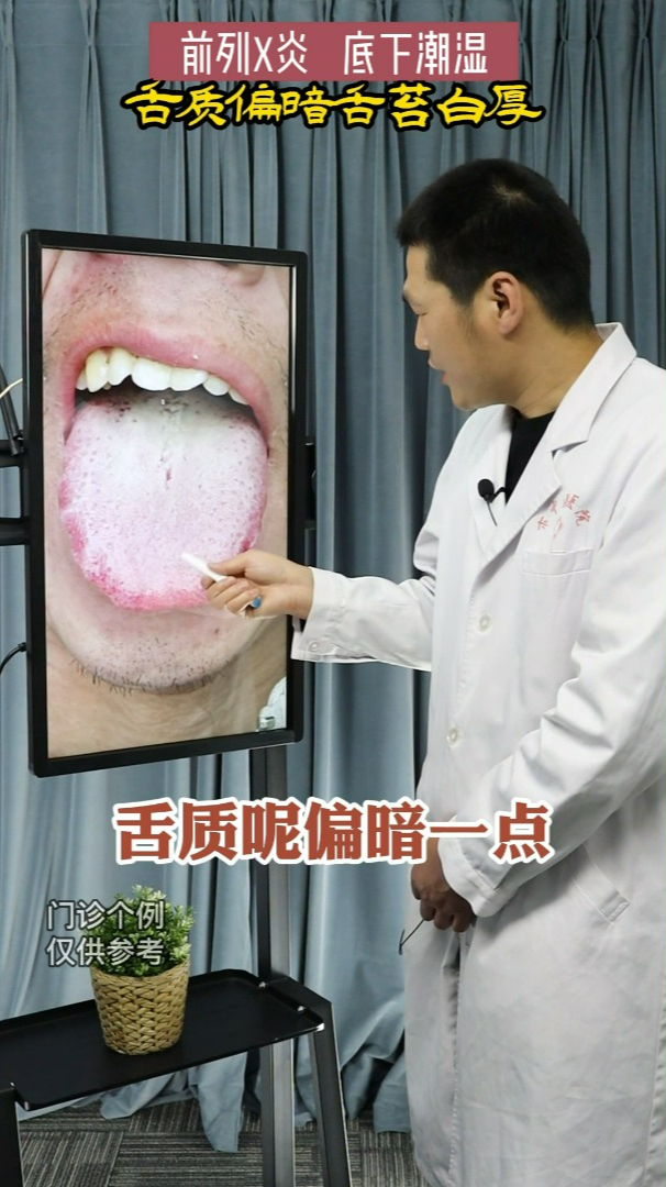 舌诊案例:前列腺炎,阴囊潮湿,舌质暗舌苔白厚-度小视
