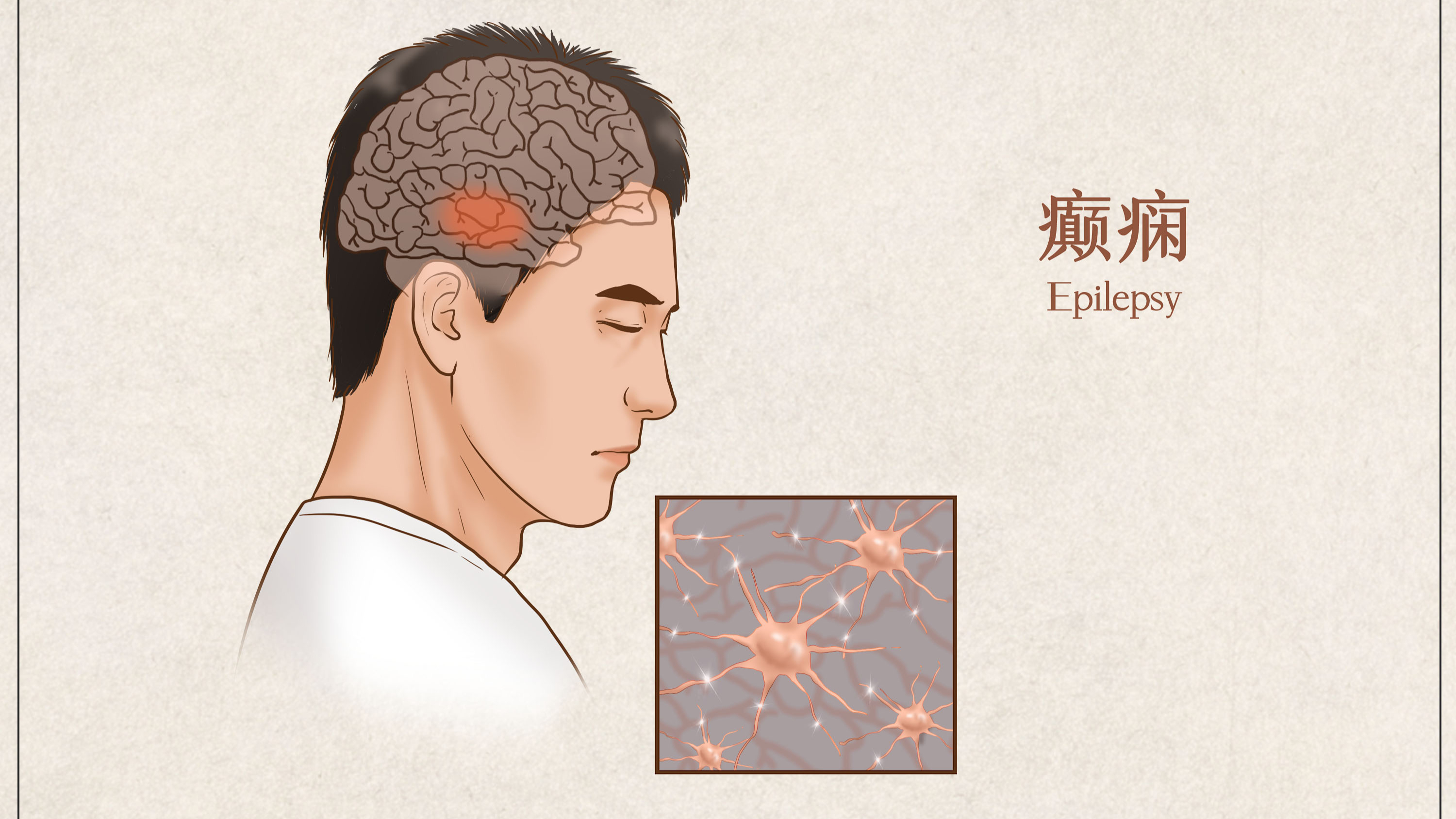 小儿癫疯病有得医吗,治好的概率有多大?