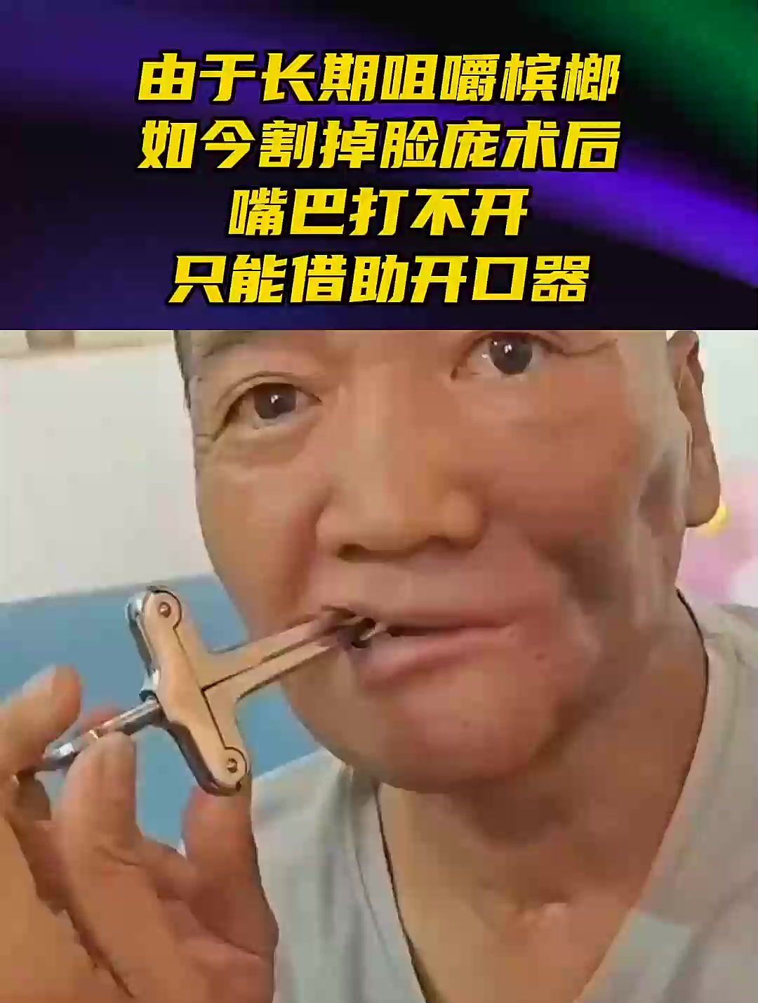 由於長期咀嚼檳榔,如今割掉臉龐.術後嘴巴打不開只能藉助開口器