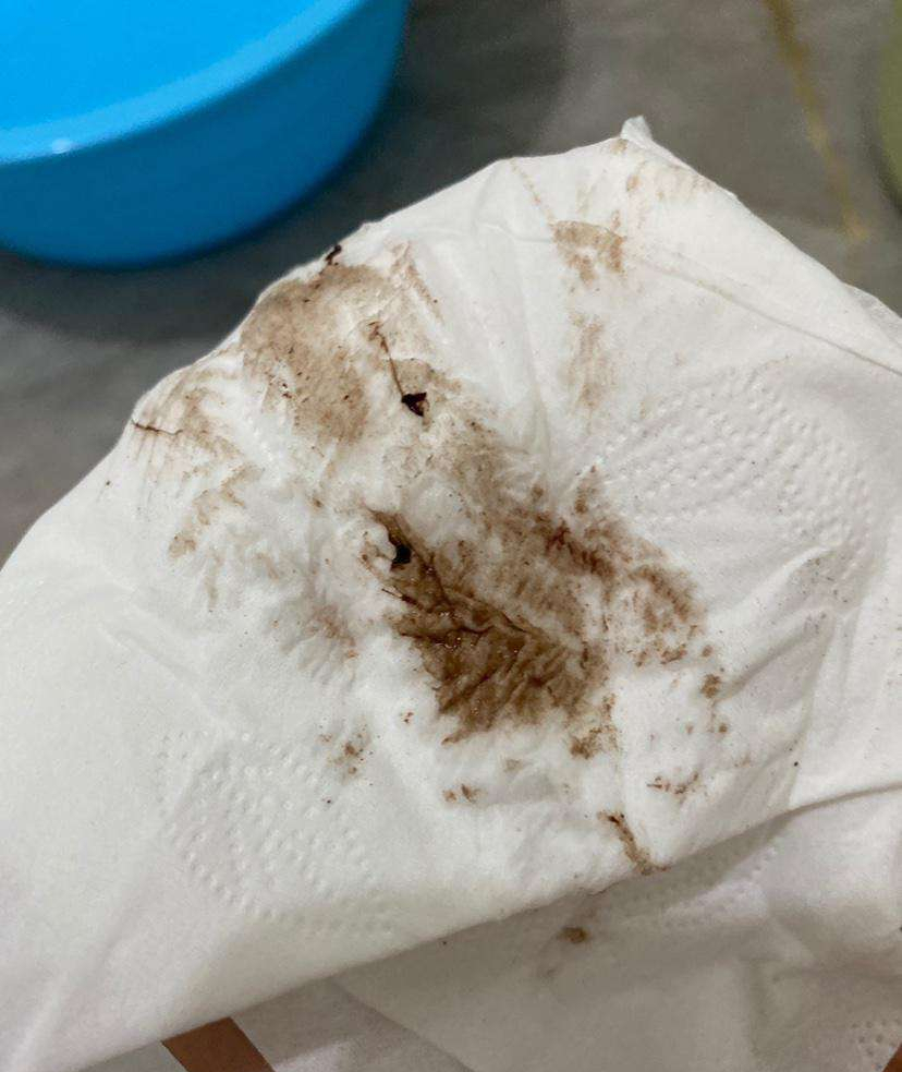 保胎期间一直有褐色血怎么办,怎样判断胎儿是否还在