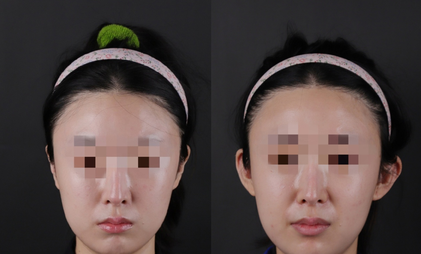 贴面耳用手拽可以变大?别被忽悠了!