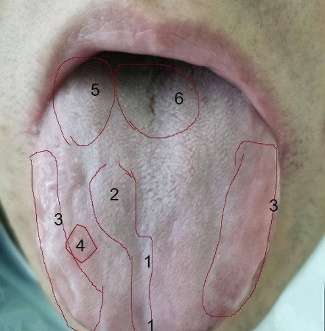 六区,巧妙学习舌相02020202  1号区域向下凹陷,说明肺气不足