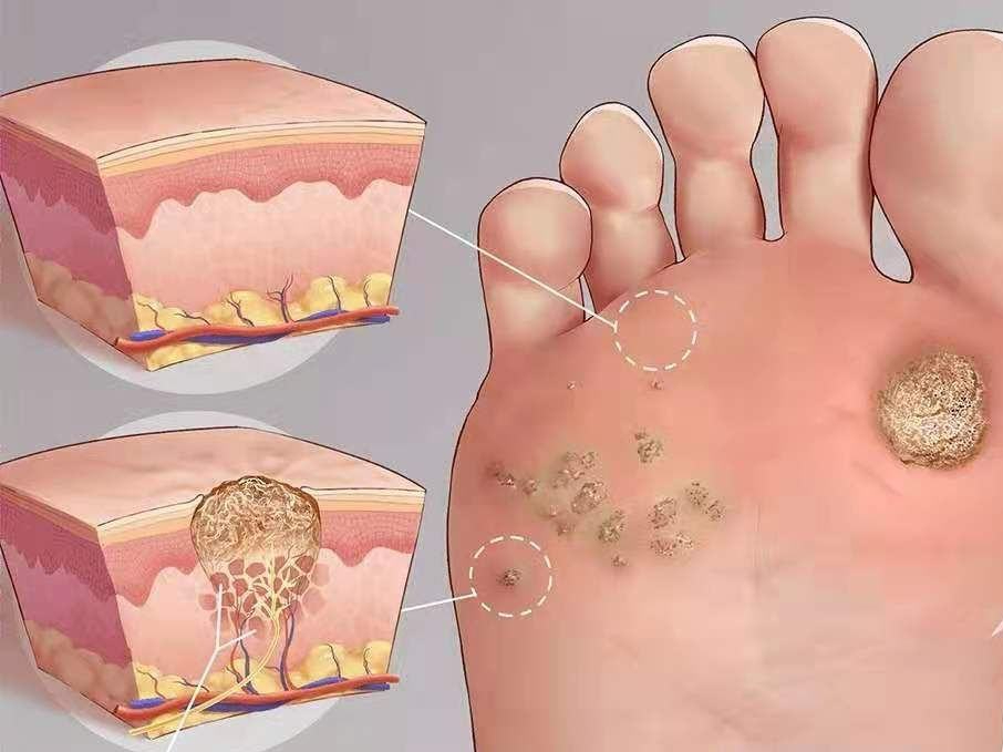 鸡眼是什么东东?反复出现应该怎么办?又该如何预防和治疗呢?