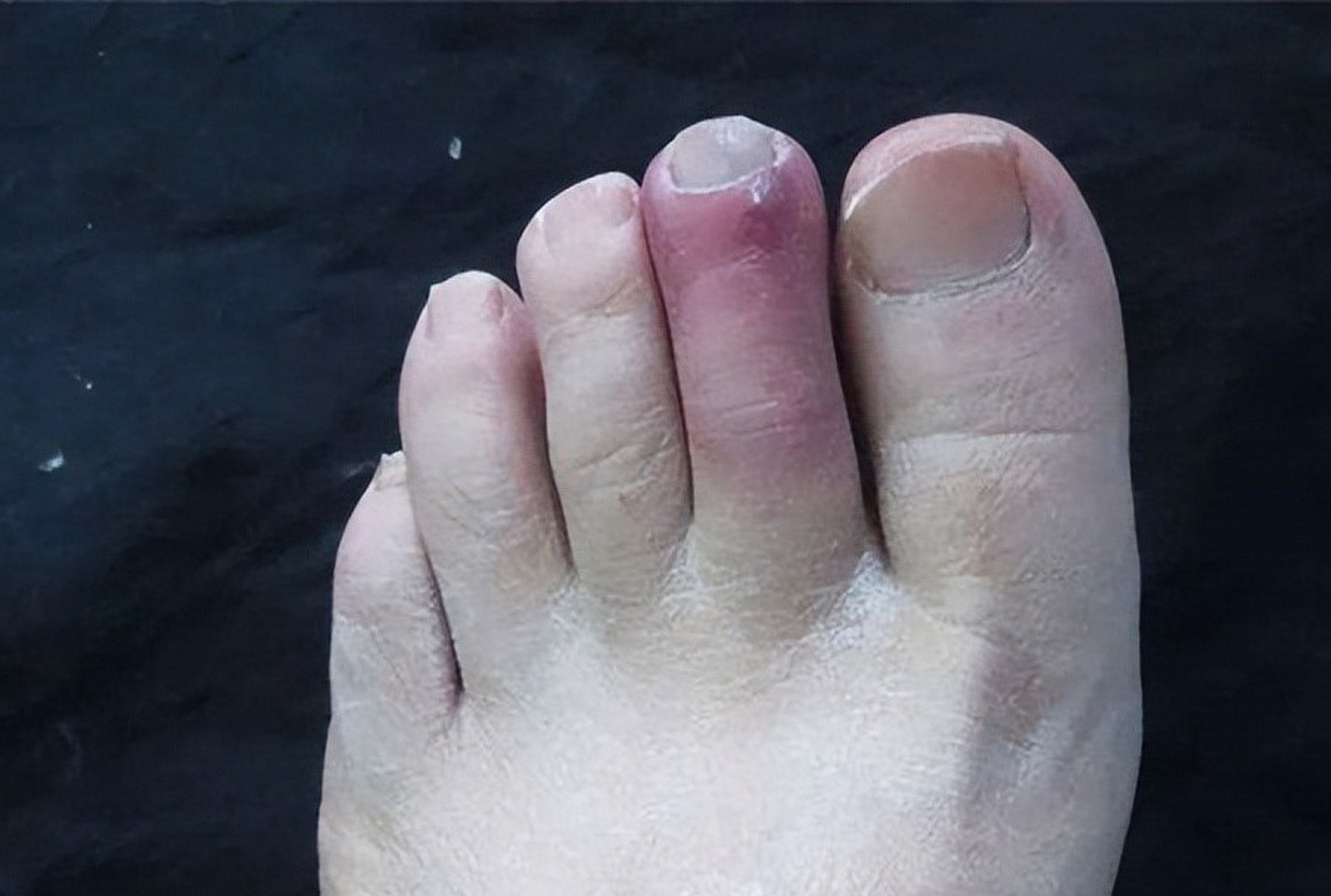 足部出现4个症状,当心糖尿病足  1.