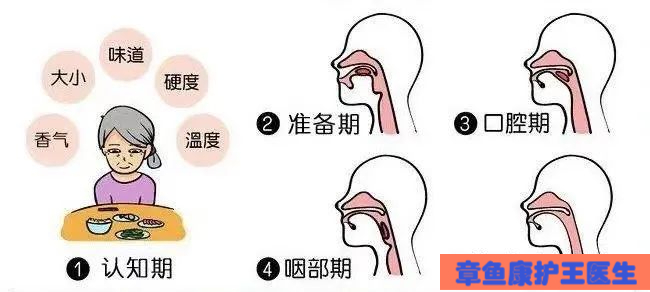 30%-65%的脑卒中患者存在吞咽障碍?如何康复锻炼,你需要知道