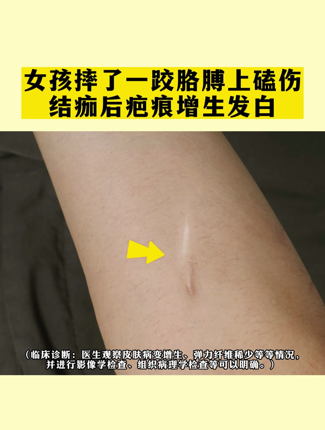 女孩摔了一跤胳膊上磕伤结痂后疤痕增生发白……-度小视