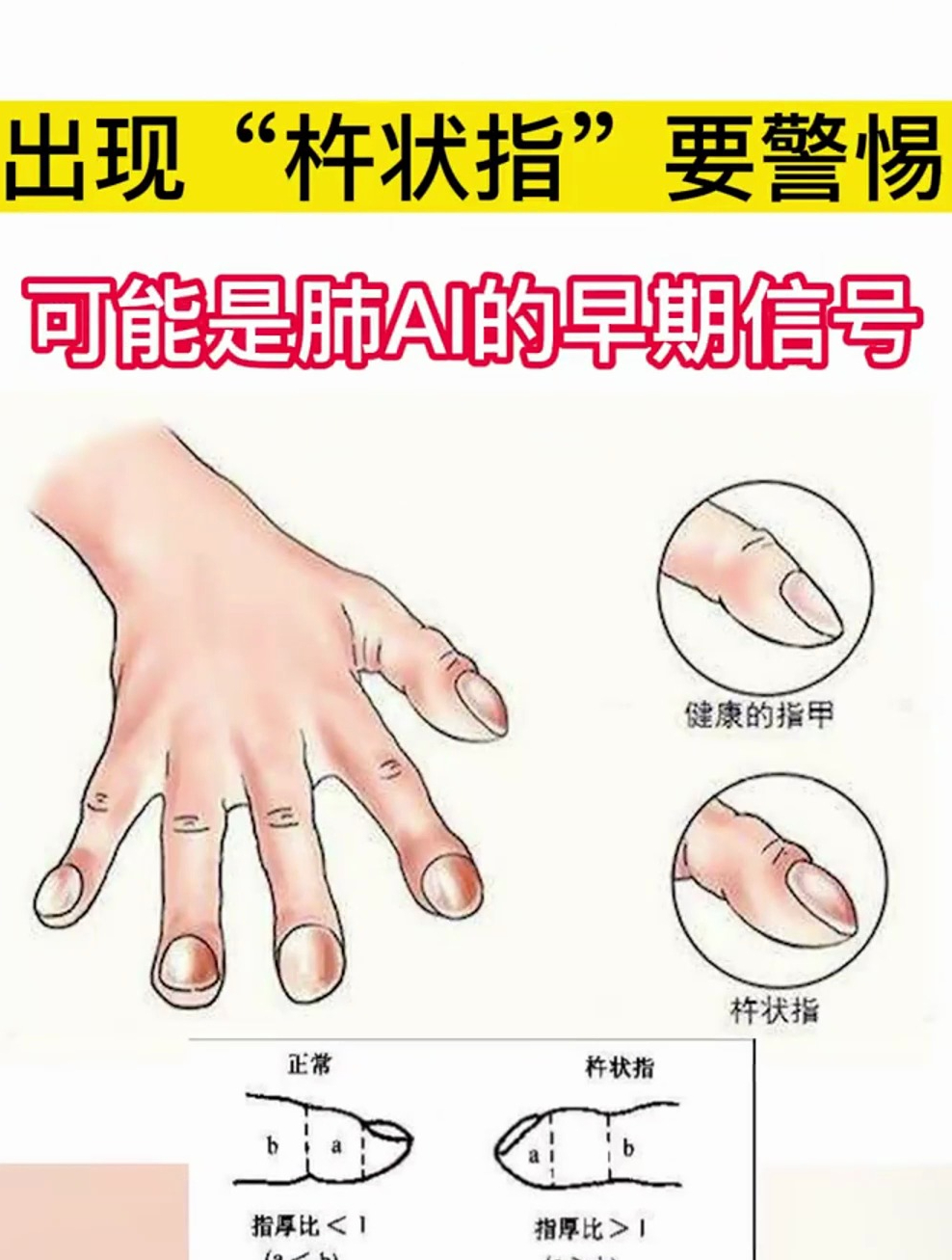 出现杵状指要警惕可能是肺癌的早期信号-度小视
