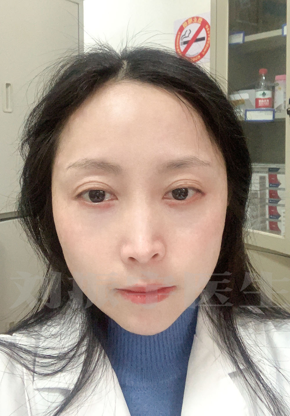 35歲白領祛眼袋一個月真實記錄,做完眼袋改變有多大?進來看對比