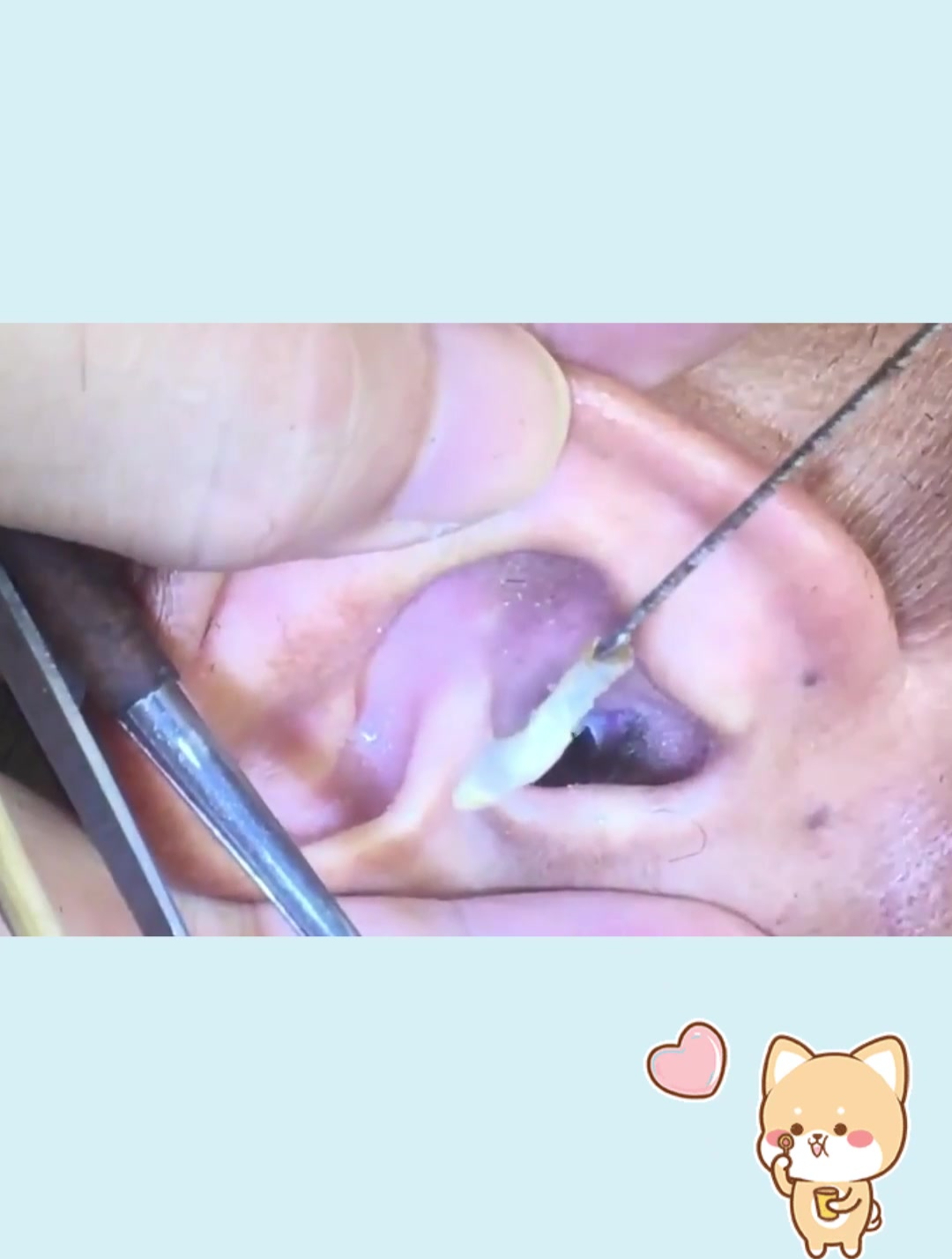 难怪平时叫婆婆时,反应这么迟钝,原来是耳朵被耳结石堵住了