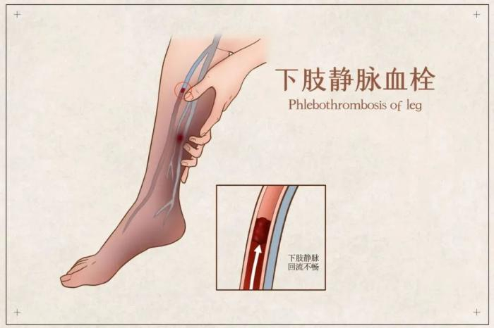 健康科普|走进下肢深静脉血栓的世界