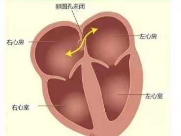 什么是卵圆孔未闭,都需要做哪些检查