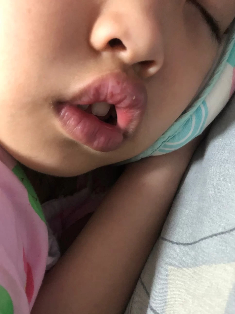 孩子腺样体肥大,保守治疗很简单