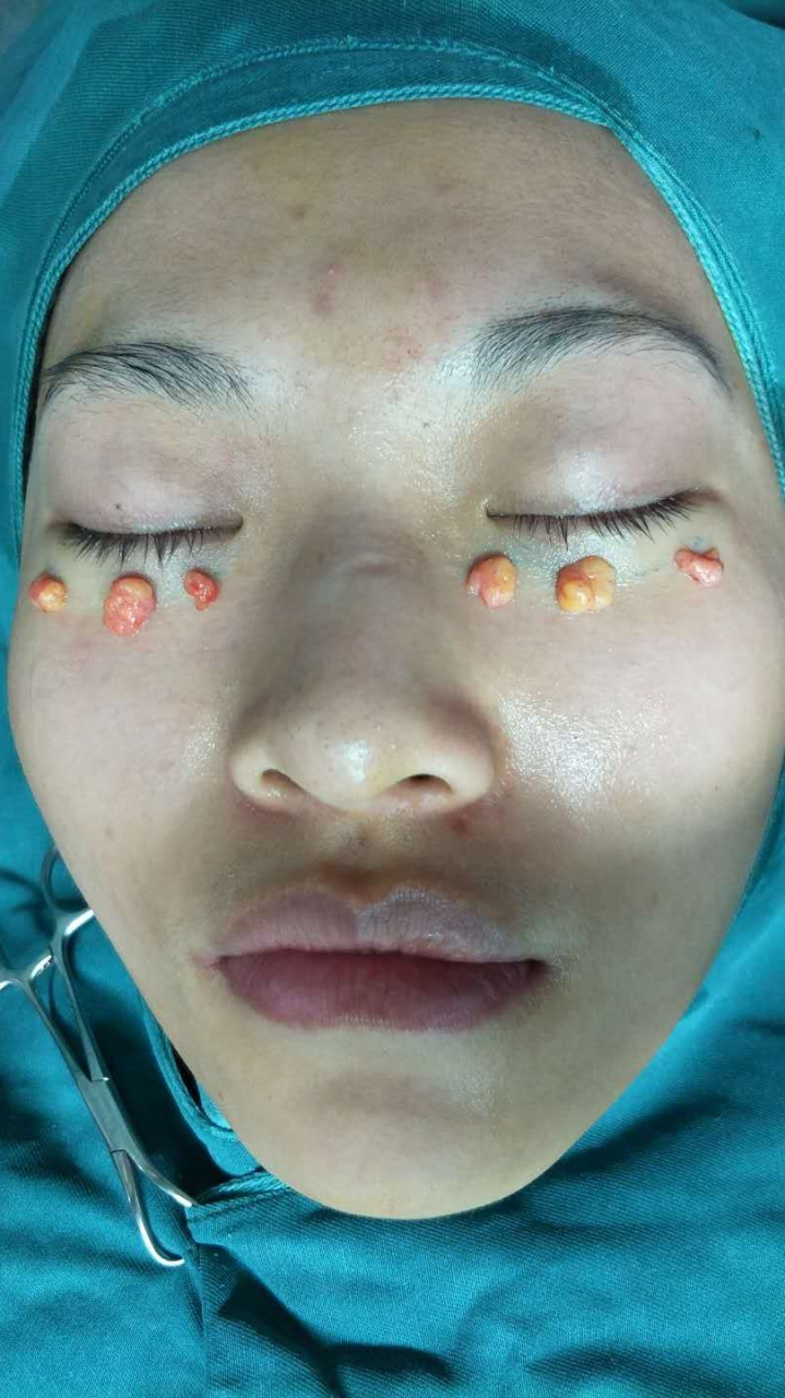 做个眼袋手术,把卧蚕给弄丢了这到底是怎么回事!