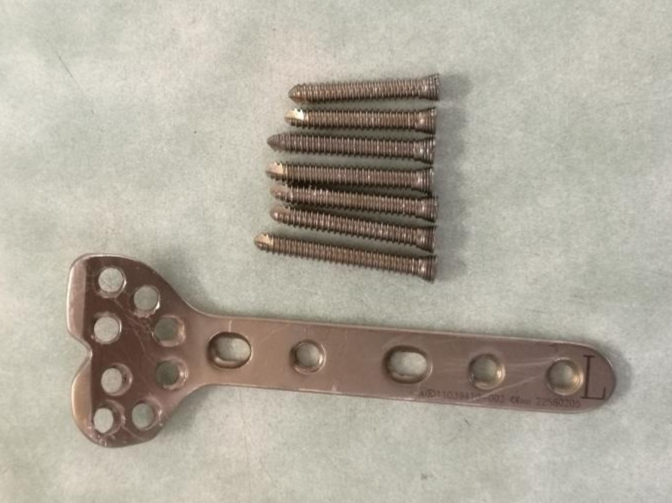 骨折愈合后钢板要不要取出