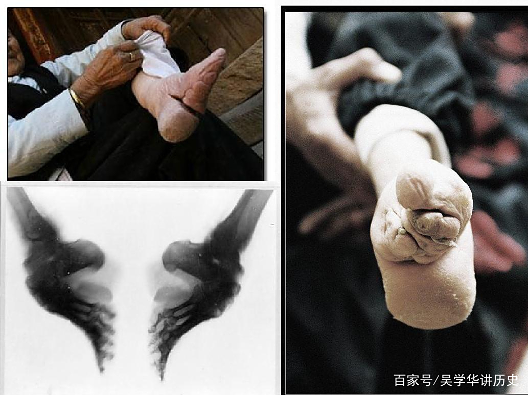 为什么要裹脚