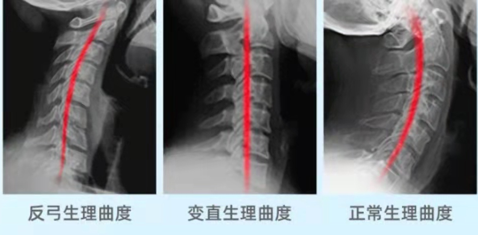 颈椎生理曲度消失图片