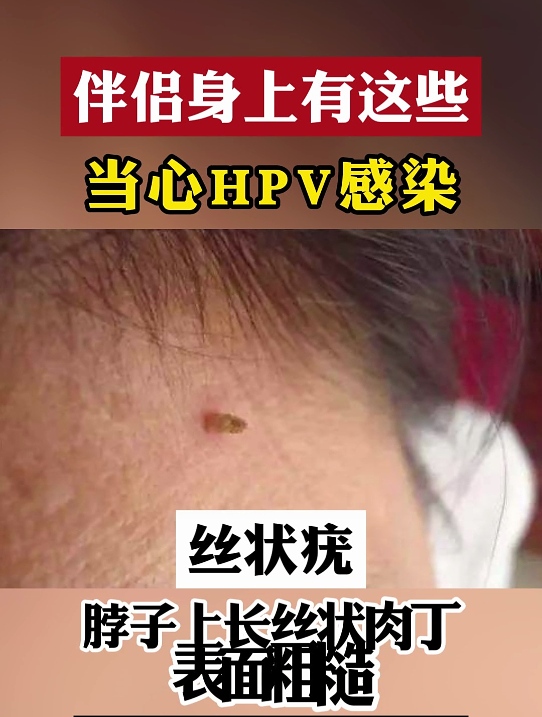 伴侣身上有这些,当心hpv感染