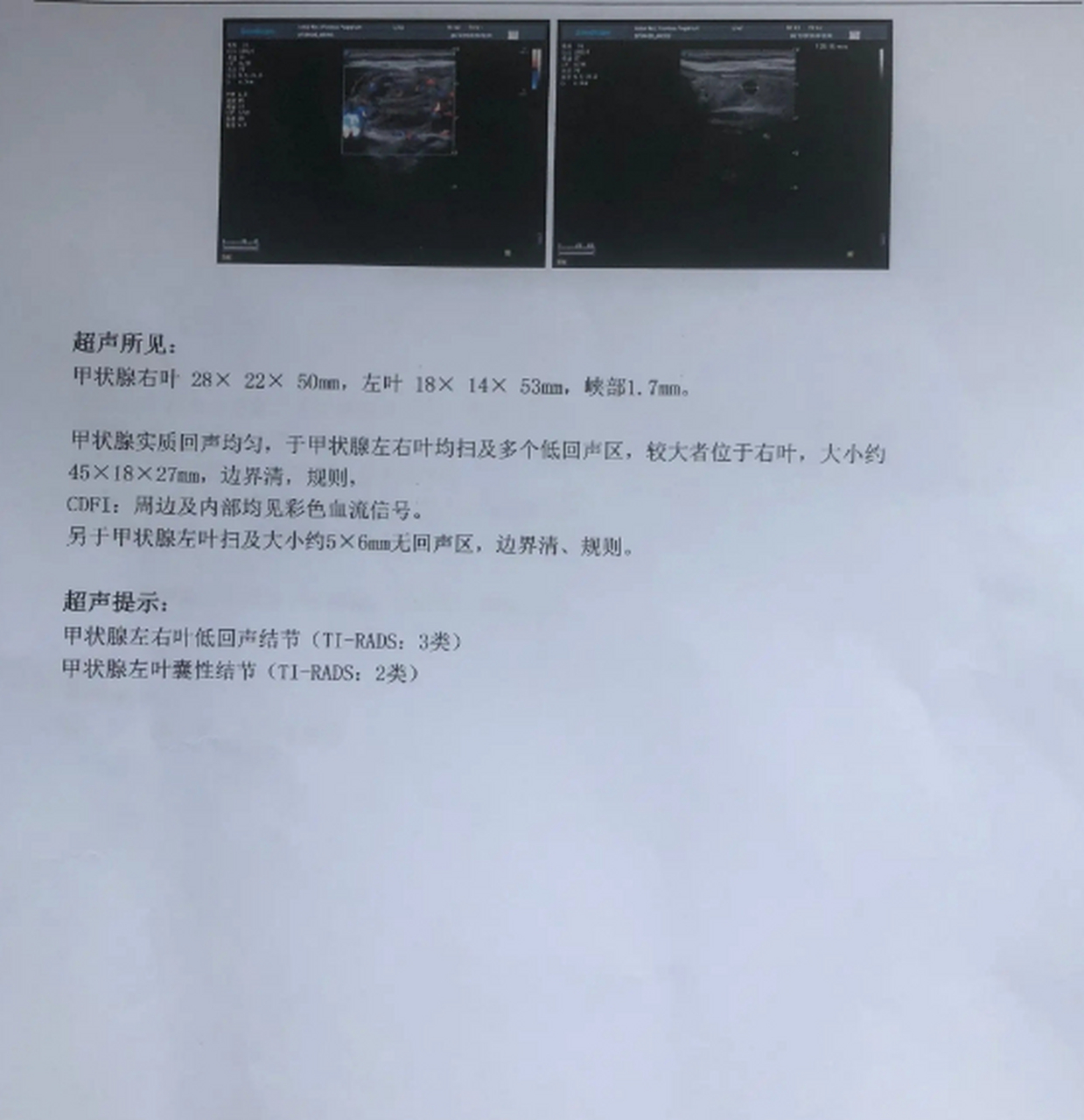 怎樣通過超聲報告,發現甲狀腺癌變 當甲狀腺結節剛開始發生癌變時,從