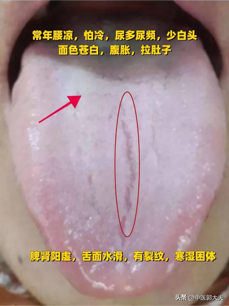 大家可以看到这个舌相,舌头上裂纹,舌苔白腻,舌头表面光滑水润