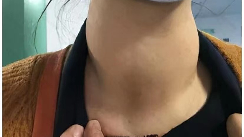 6年大粗脖辛酸史!遇到它终于治好了!