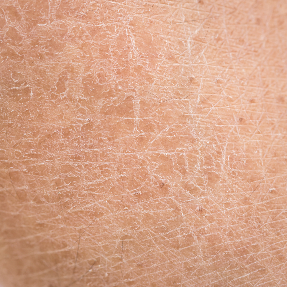 肌肤干燥起皮类似鱼鳞?当心患上鱼鳞病!