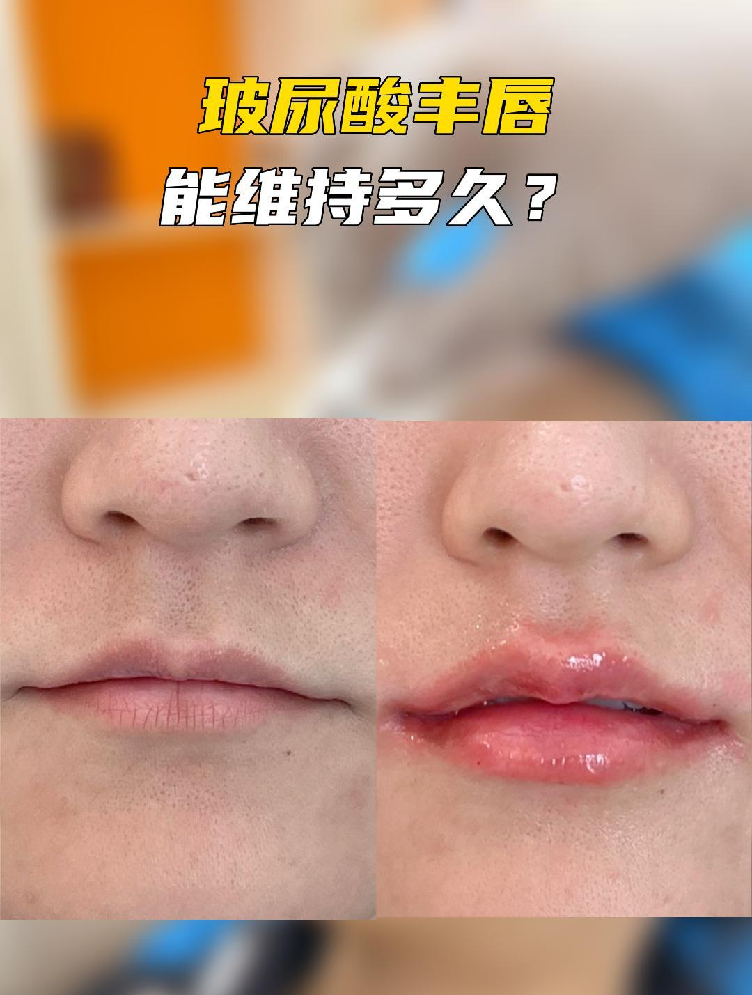 玻尿酸丰唇能维持多久?