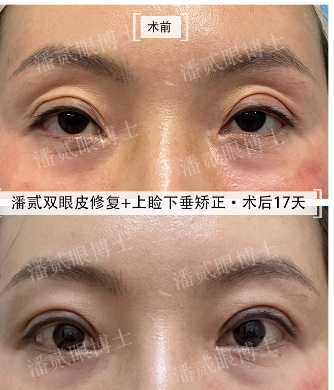 凸眼睛·潘贰双眼皮修复 上睑下垂矫正·术后17天