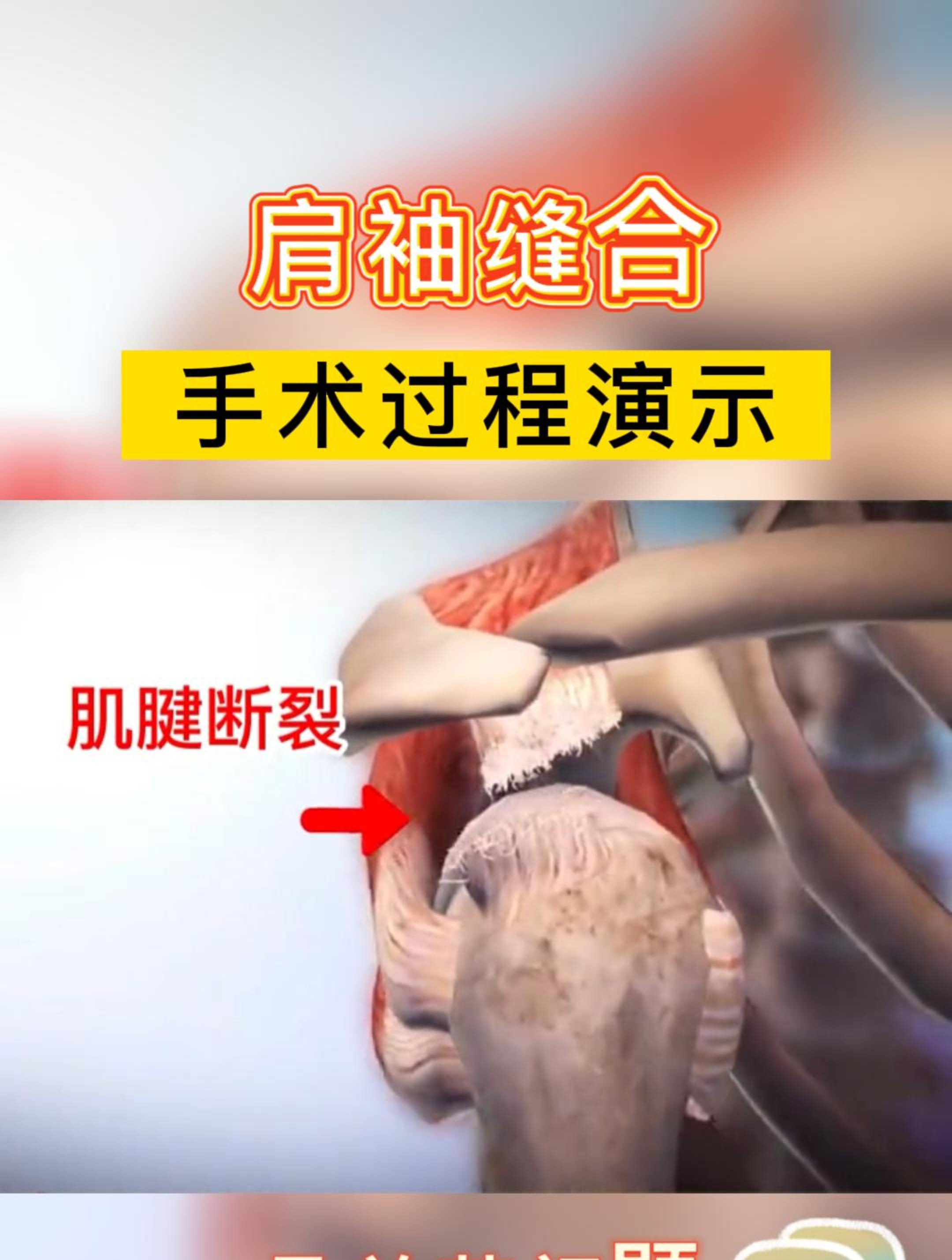 肩袖缝合,手术过程演示!