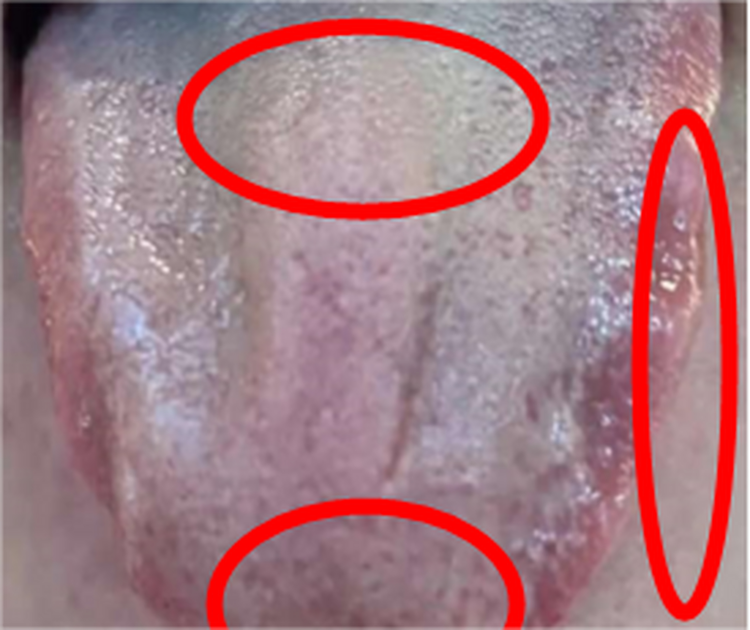 今天给大家分享一个患者舌相  大家可以看出来这个舌相,舌质发红,舌中