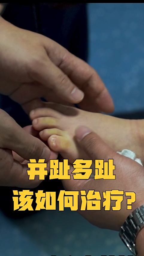 都说脚趾并在一起的人上辈子是美人鱼来看看医生是怎么帮她的