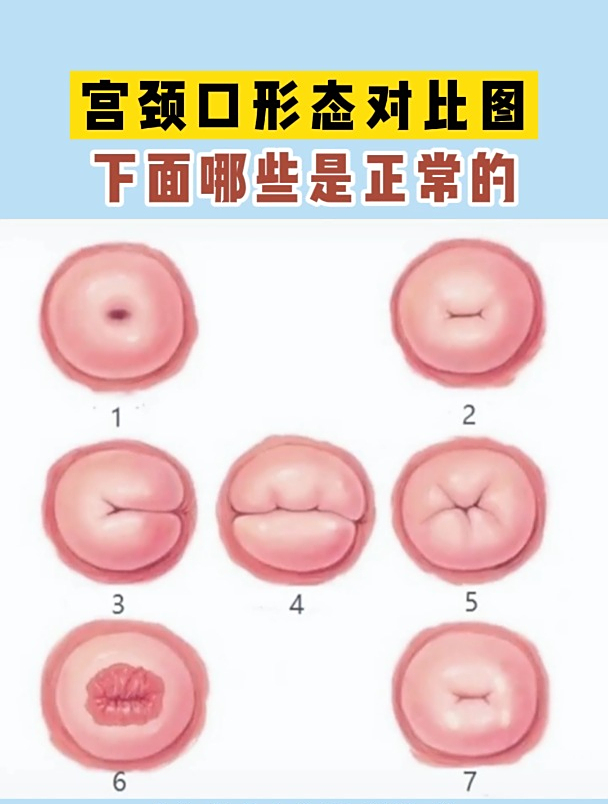 宫颈口形态对比图 下面哪些是正常的