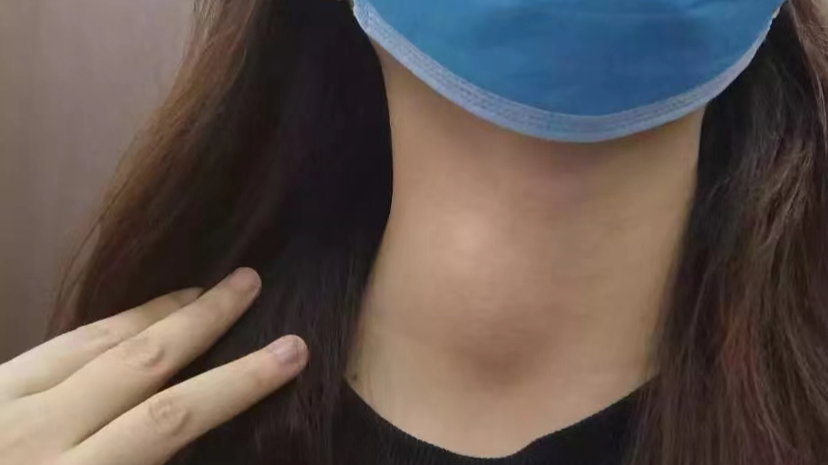 得了甲状腺结节快用"黄金搭档"!内调 外治,专治大粗脖子!