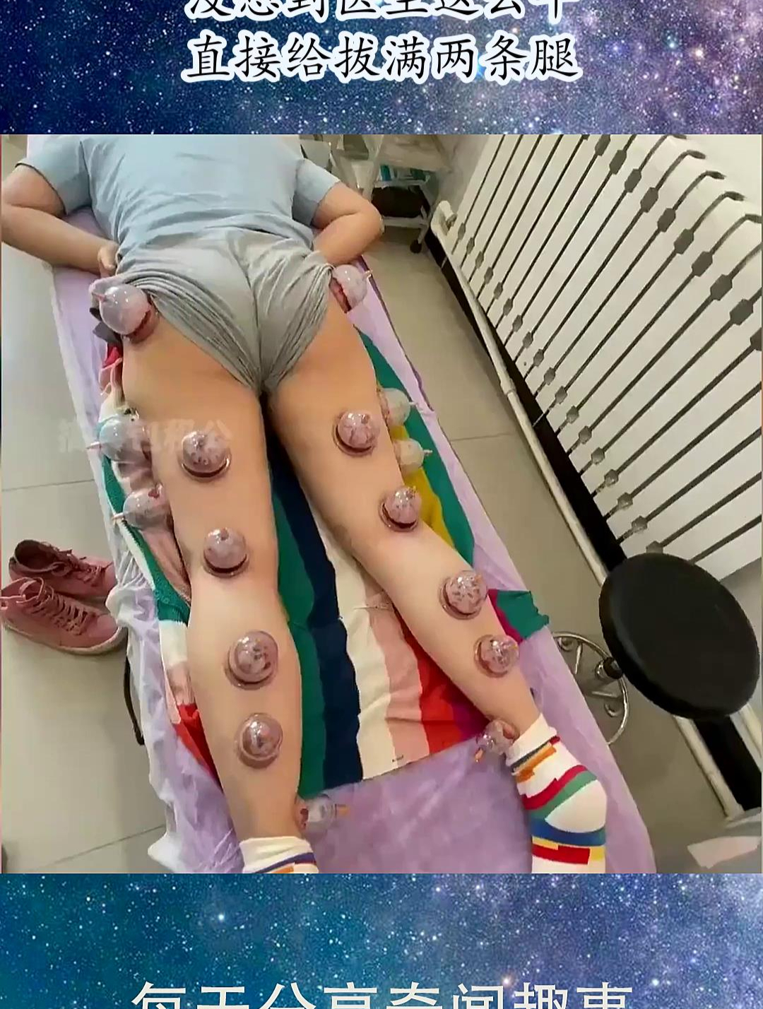 患风湿病的美女去拔罐,没想到医生这么牛,直接给拔满两条腿!
