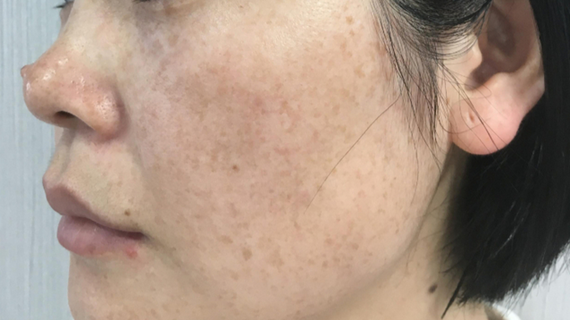 黄褐斑就是体内有淤,仅8味药,肝气通了,黄褐斑自然就好了 39岁的郝