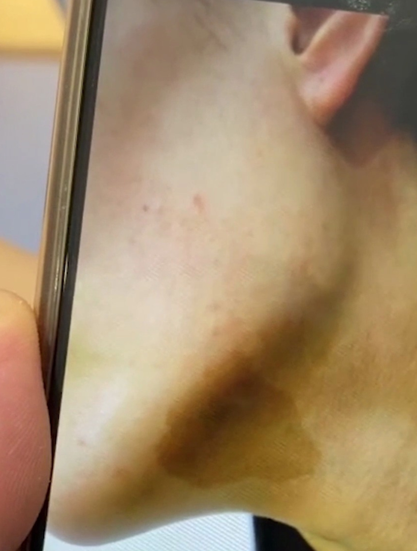 脖子上有大片的咖啡斑怎么办?现在看下她的修复情况!