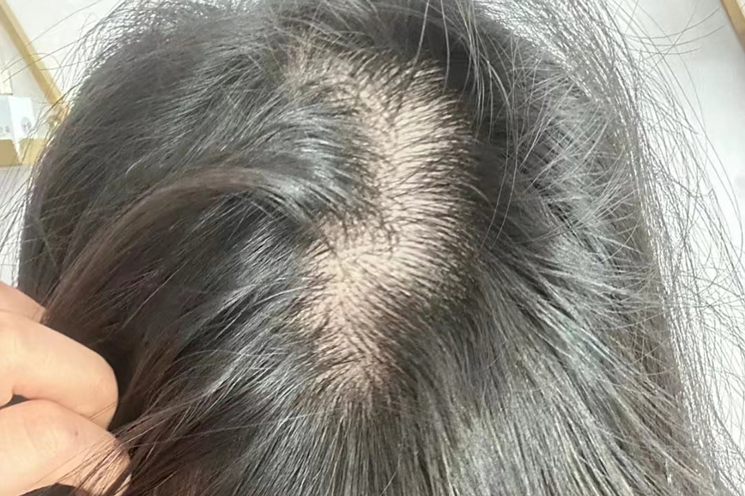 发际线高?发缝变宽?快用这个养发宝典!分分钟发量翻倍!