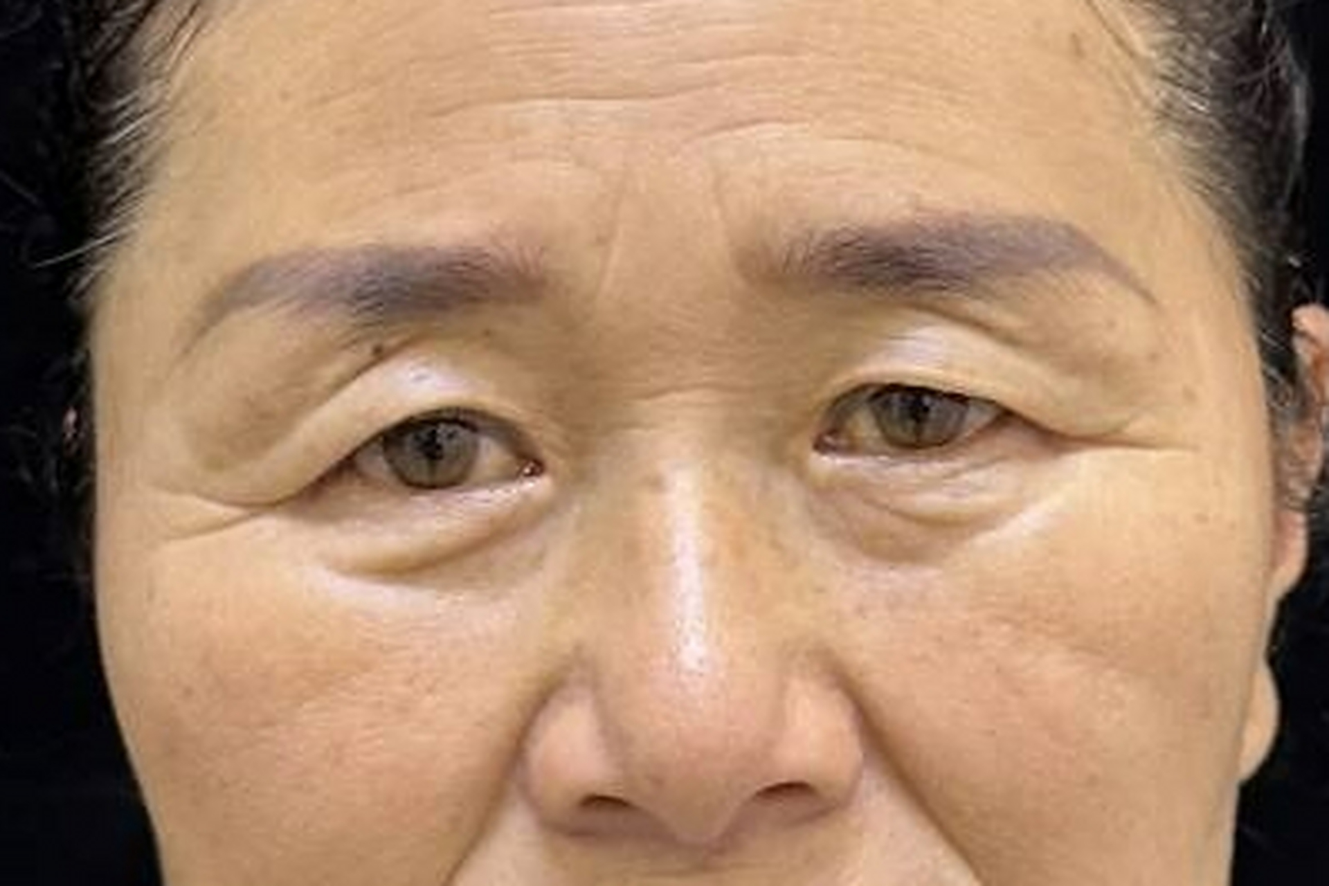 60岁大妈眼皮松弛耷拉,提眉切掉1厘米皮肤,精神太多了!