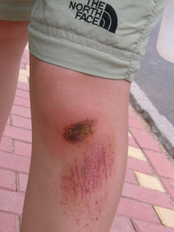 注意了,有皮肤破损,最好延期进行人工关节置换手术!